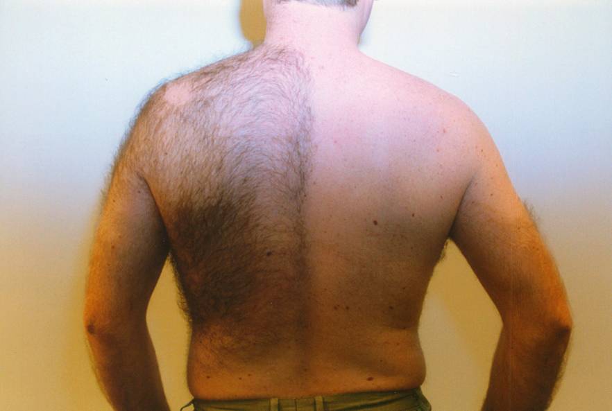 permanent back hair removal