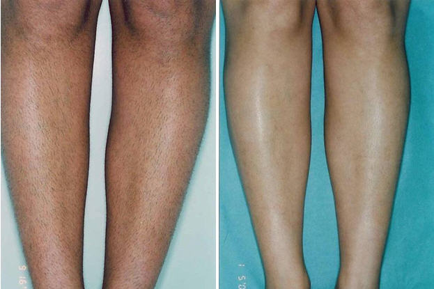 laser hair removal legs cost reddit