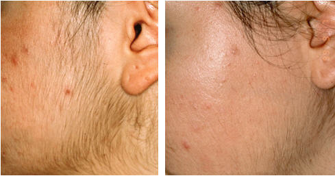 laser hair removal facial hair