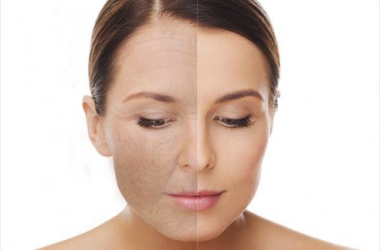 Skin resurfacing, Ellipse IPL, Blue Sage Spa